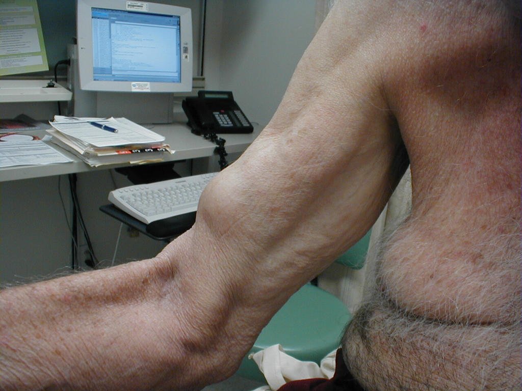 upper_biceps_rupture.jpg
